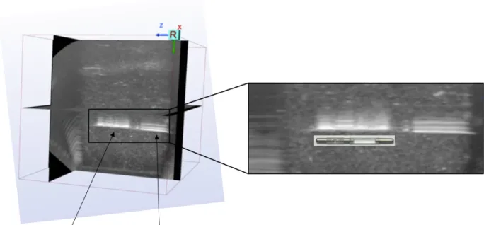 Figure 9: 3D US phantom image showing a needle during releasing stranded seeds.