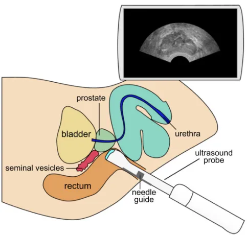 Figure 1. TRUS-guided biopsy procedure