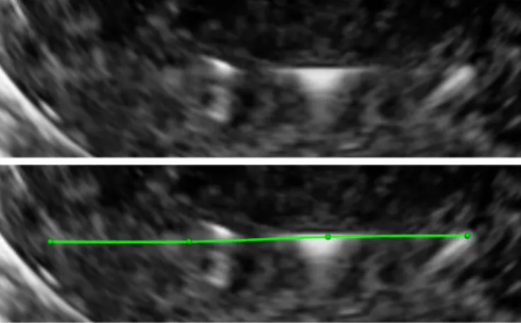 Fig. 10: Example of bad visibility of a steel needle in a 3D ultrasound volume. Top picture: original volume