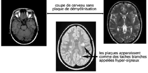 Figure 3 : Visualisations des plaques sur une IRM encéphalique d’un patient sain  et d’un patient atteint de SEP