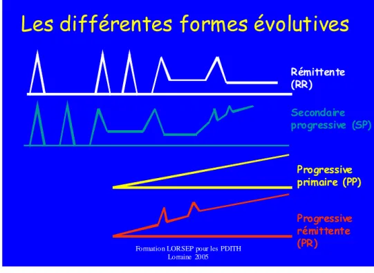 Figure 4 : Les différentes formes évolutives de la SEP [5] 