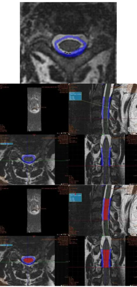 Figure 1-4 : Four successive steps of cervical spinal cord segmentation 