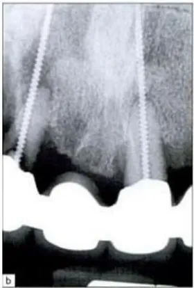 Illustration 5 : Implant endodontique (D’après Szmukler-Moncler S. et coll, 2008) 