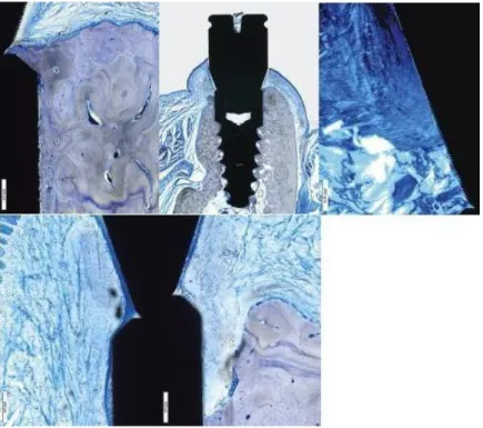 Illustration 32 : Résorption et régénération osseuse sur un pilier nervuré au laser (Nevins M 