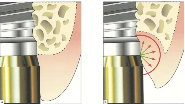 Illustration  35 : a : joint implant pilier classique en bout à bout. b : réaction de diffusion l’inflammation  chronique au niveau de la connexion implant/pilier