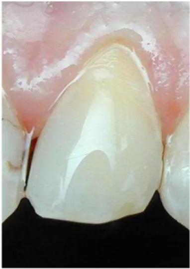 Figure 11 et 12 : photographies montrant une lésion cervicale d’usure (doublée d’une  restauration mésiale vestibulaire) avant et après obturation à l’aide d’une résine  composite fluide (Document : Dr Eric Mortier) 