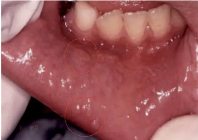 Figure  35  :  Hyperplasie  épithéliale  focale  sur  la  face  interne  de  la  lèvre  inférieure chez un enfant de 10 ans (d’après Burkhart, 2012)