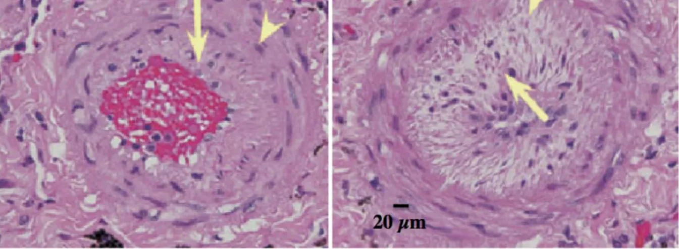 Figure 1. Coupes transverses d’une artère pulmonaire d’après  Zaiman et al. A: hypertrophie de la média  (tête  de  flèche),  épaississement  intimal  (flèche)  