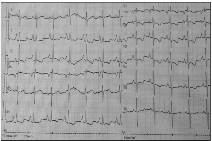 Figure 3. ECG typique d'une hypertension pulmonaire. 