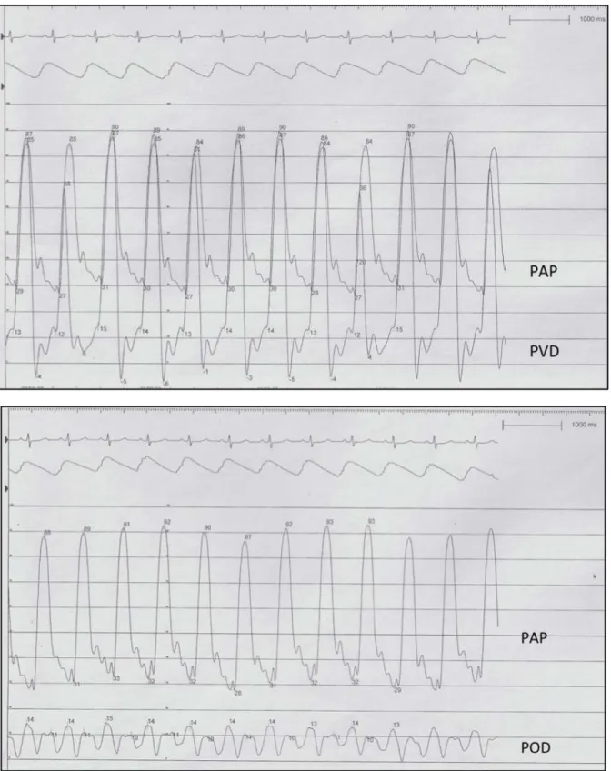 Figure 4. Courbes de pression dans les cavités droites lors des cycles cardiaques  