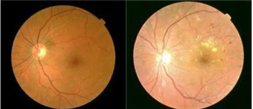 Figure 5 : A gauche, un fond d'œil normal, à droite un fond d'œil avec rétinopathie  évoluée