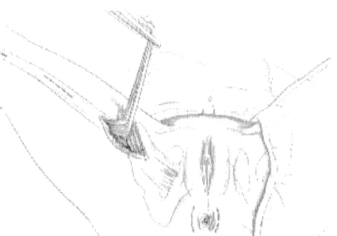 Figure 3 : Incisions de la cuisse et du périnée et dissection du gracile (21)