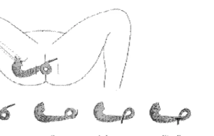Figure 4 : configurations possibles du muscle transposé