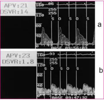 Figure  7:  Comparaison  d'un  flux  coronaire  en  cas  de  no-reflow  (a)  et  après  reflow  normal  (b) ;  d’après  Iwakura et al.(57) 