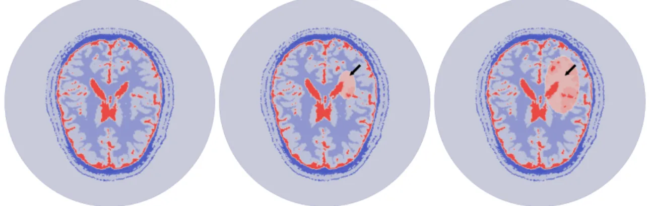 Figure 6: Imaginary part of the exact permittivity for a time evolution of a synthetic hemorrhagic stroke