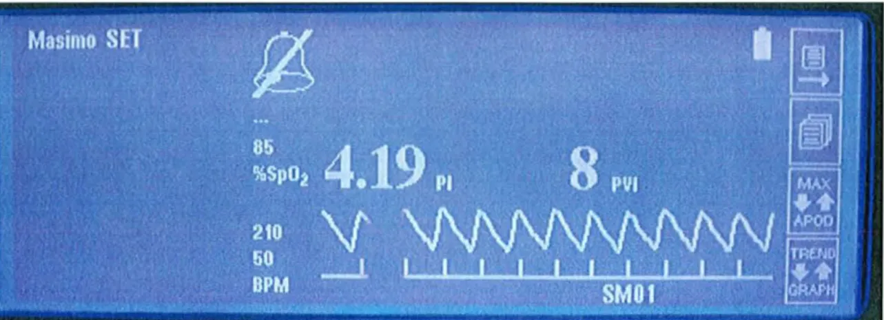 Figure 8 : Exemple d'écran d'oxymètre de pouls affichant les paramètres de pholopléthysmographie