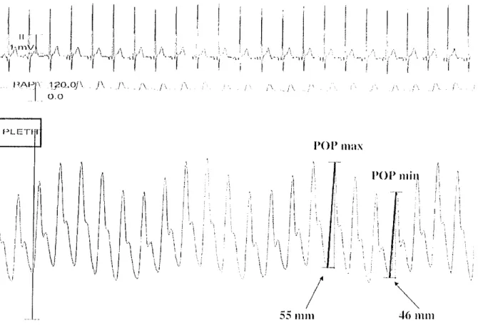 Figure 9 : Analyse de la courbe de l'onde de pléthysmographie, POP=PPLET [118].
