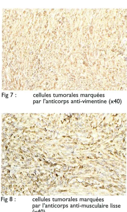 Fig 7 cellules tumorales marquées