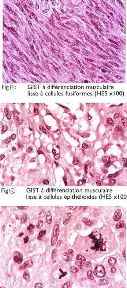 Fig jLj: GIST à différenciation musculaire lisse à cellules fusiformes (HES xl 00)