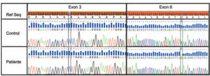 Figure 2: Genetic diagnosis of aurora kinase C (AURKC) exons 3 and 6.