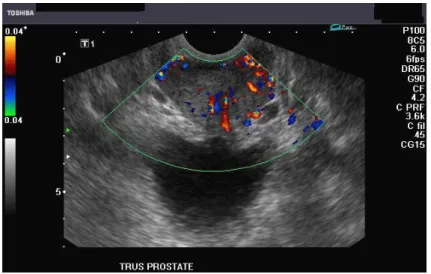 Fig. 2.5 – Imagerie Doppler de la prostate. Les vitesses faible d’écoulement ne sont pas estimées car elles ont été filtrées.