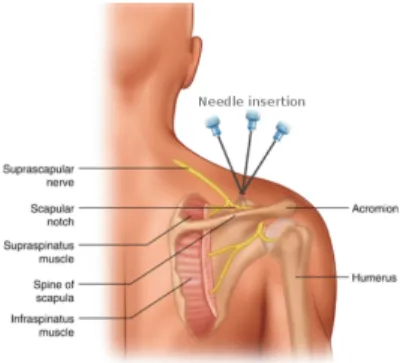 Figure 1. Needle insertion in the shoulder ([4]).