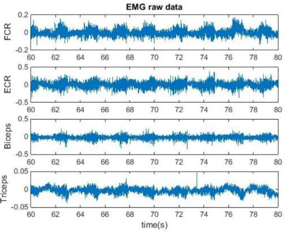 Figure  4  shows  a  typical  EMG  raw  data  recorded  for  a  20  seconds  period  of  5  minutes task