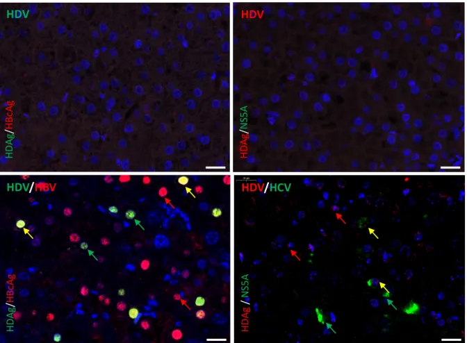 Figure 1. Immunohistochemistry of livers from HDV/HCV co-infected HuHep mice. 4-8 weeks old NOD-FRG  mice were engrafted with primary human hepatocytes (PHH)