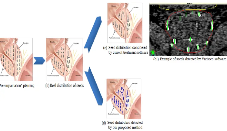 Figure  2.  Seed  distribution  in  prostate  brachytherapy:  (a)  Seeds  aligned  with  the  insertion  direction  as  defined  in  the  planning  (from  http://cancer.uc.edu/cancerinfo/TypesOfCancer/ProstateCancer/InterstitialBrachtherapy.aspx); (b) Real