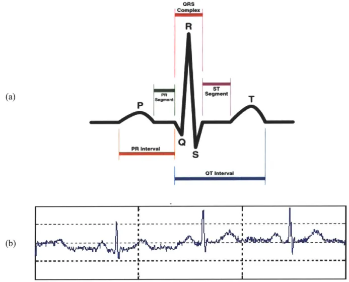 Figure  1-3.  Electrocardiogram.  Figure  I-3a  depicts  the  parts  of  a  single  heartbeat  in  the electrocardiogram