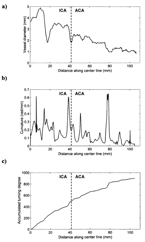 Figure  9  Geometric  analysis  of the  Al,  A2,  and  A3  segments  of the  right  ACA  and  the right  ICA  supplying them