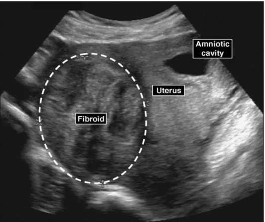 Figure 3: Nécrobiose aseptique d'un fibrome  