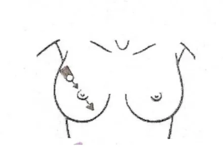 Figure 7 : recherche d'une connexion cutanée par traction sur le mamelon [13] 
