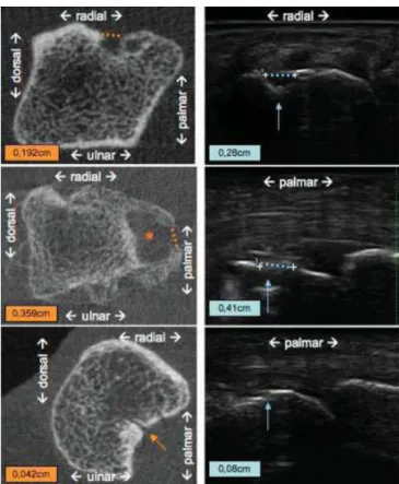 Figure 8 : comparaison d‘érosion en TDM et en Echographie (40) 