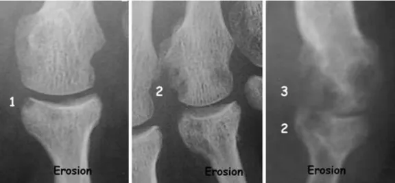 Figure 4 Quelques exemples d’érosions radiographiques 