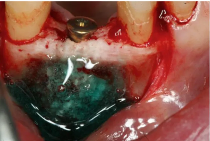 Figure 21 : 1 er  cas, Mise en place de l’implant en 42, fenestration recouverte par du  Bone Ceramic et Membragel, 16 mai 2011 (DR