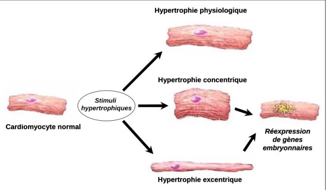 Figure  10  Schéma  représentant  la  morphologie  des  cardiomyocytes  dans  les  différents  types  d’hypertrophie  cardiaque  (D’après  Hunter  et  Chien,  1999)