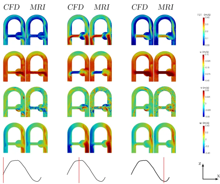 FIGURE 5 Comparison in the coronal plane of CFD velocity fields with MRI measurements at 2 mm resolution at different instants of the cycle