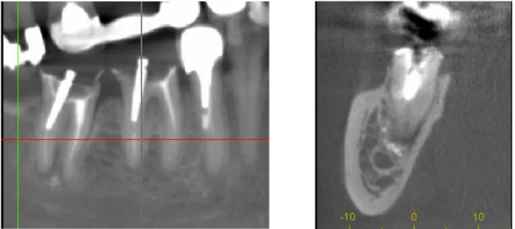 Figure 12: Racine distale de la 47 présentant une lésion apicale. Proximité importante avec le canal dentaire