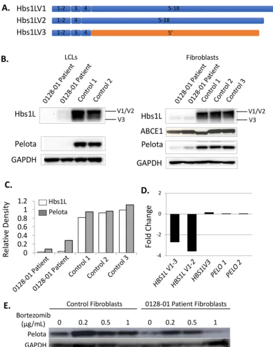 Fig 2. Biallelic mutations in human HBS1L lead to Hbs1L deficiency and decreased Pelota protein
