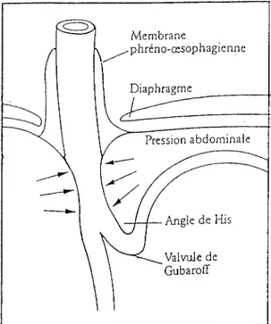 FIGURE 1 : Barrière anti-reflux : montage anatomique [12].