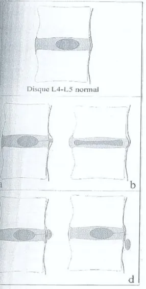 Fig. 7: Aspects de l'hernie discale