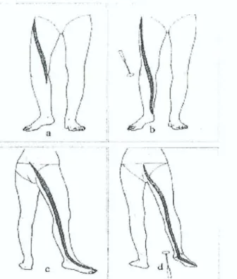 Fig. 9 : Topographie des douleurs radiculaires selon C. Manelfe a) Névralgie crurale L3.