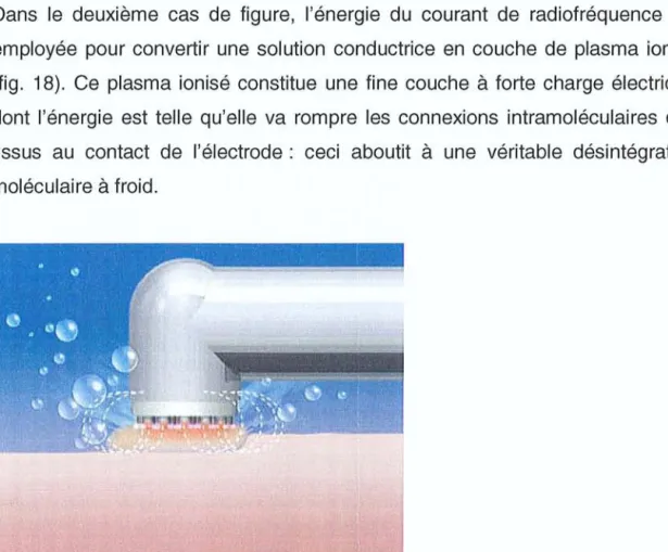 Fig. 18: électrochirurgie par coblation (bipolaire) : l'énergie du courant de RF est employée pour convertir une solution conductrice en couche de plasma ionisé