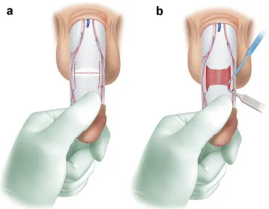 Figure 5. L'incision en H et abord de la plaque 
