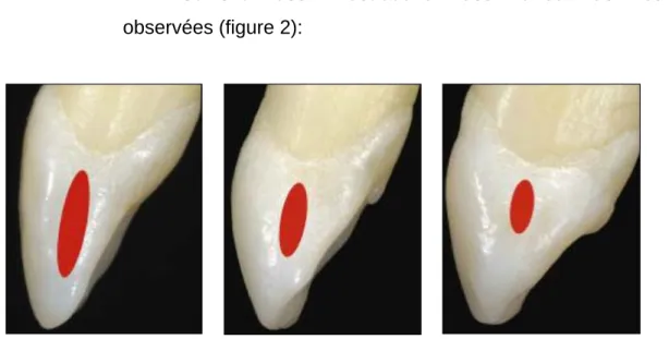 Figure 2 : surface mésiale de 21, 22 et 23 avec objectivation en rouge de la surface du PCI,  d'après Stappert C.F