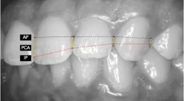 Figure 3: Profil des étendues des PCI en fonction de  la hauteur de la couronne de la dent située 