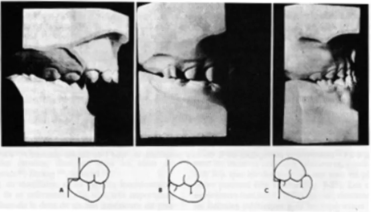 Figure 14 : Illustration du plan terminal  de Chapman. A : marche distale, B :  droit, C : marche mésiale, d’après  Lamorlette D., 1993