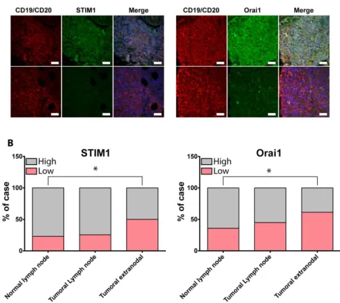 Figure  5.  Orai1  and  STIM1  expression  is  altered  in  extra-nodal  DLBCL.  (A)  Representative  immunofluorescent  staining  of  STIM1  and  Orai1  in  normal  lymph  node  and  extra-nodal  DLBCL  under-expressing  STIM1  or  Orai1