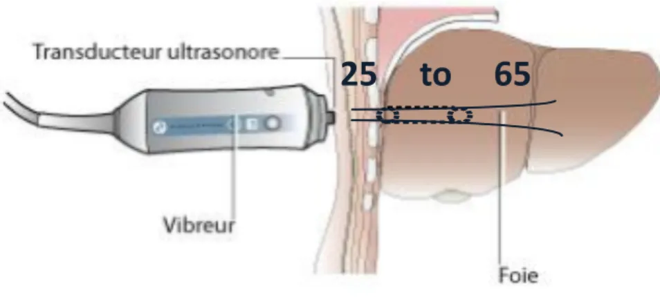 Figure  4  :  schéma  représentant  la  sonde  de  FibroScan  et  l’impulsion  mécanique  en  regard  du  lobe  droit   hépatique  